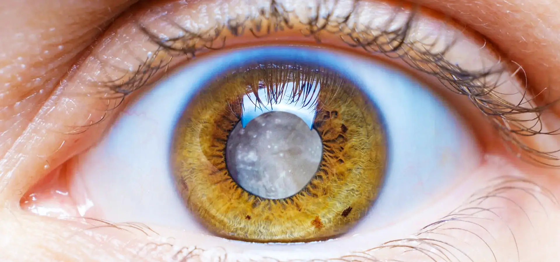 Close-up of an eye with a cataract, assessed at Eyecare Concepts Melbourne