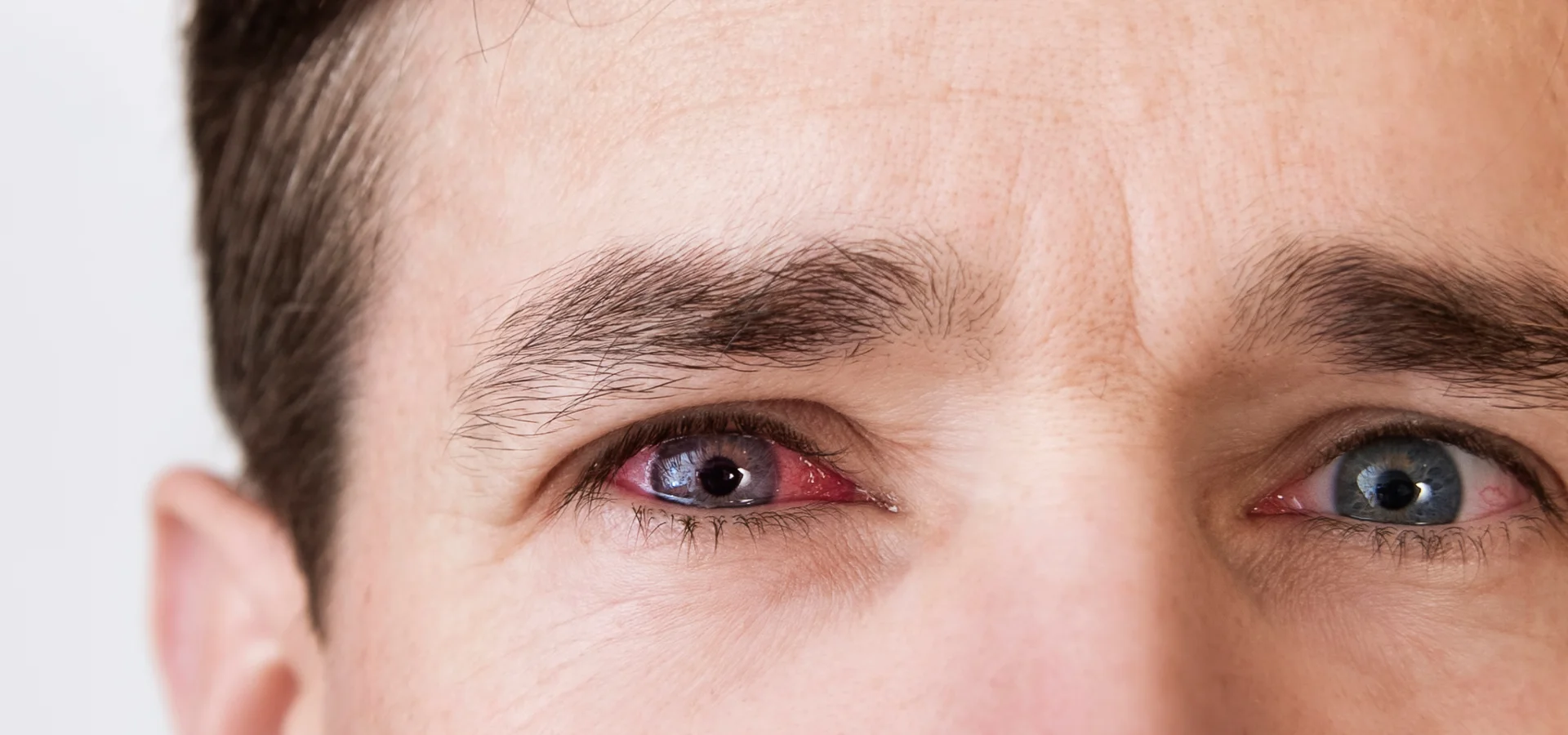 Eye examination for pink eye and conjunctivitis at Eyecare Concepts Melbourne