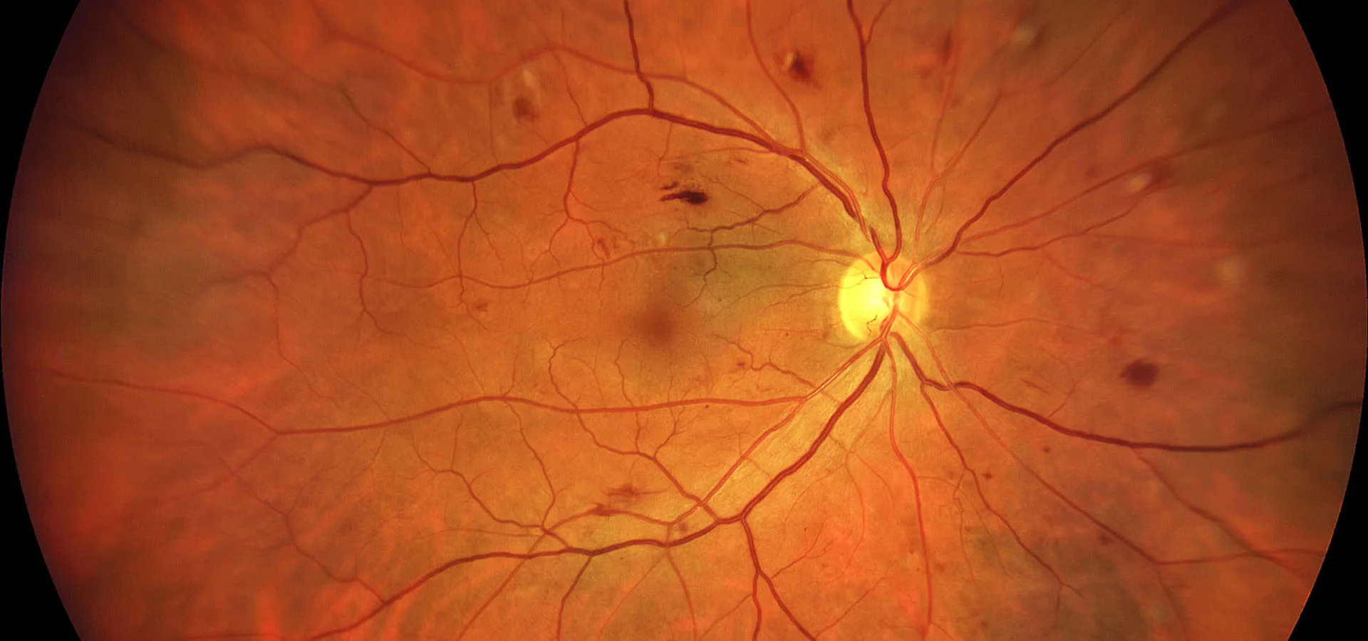 Retinal scan showing signs of diabetic retinopathy