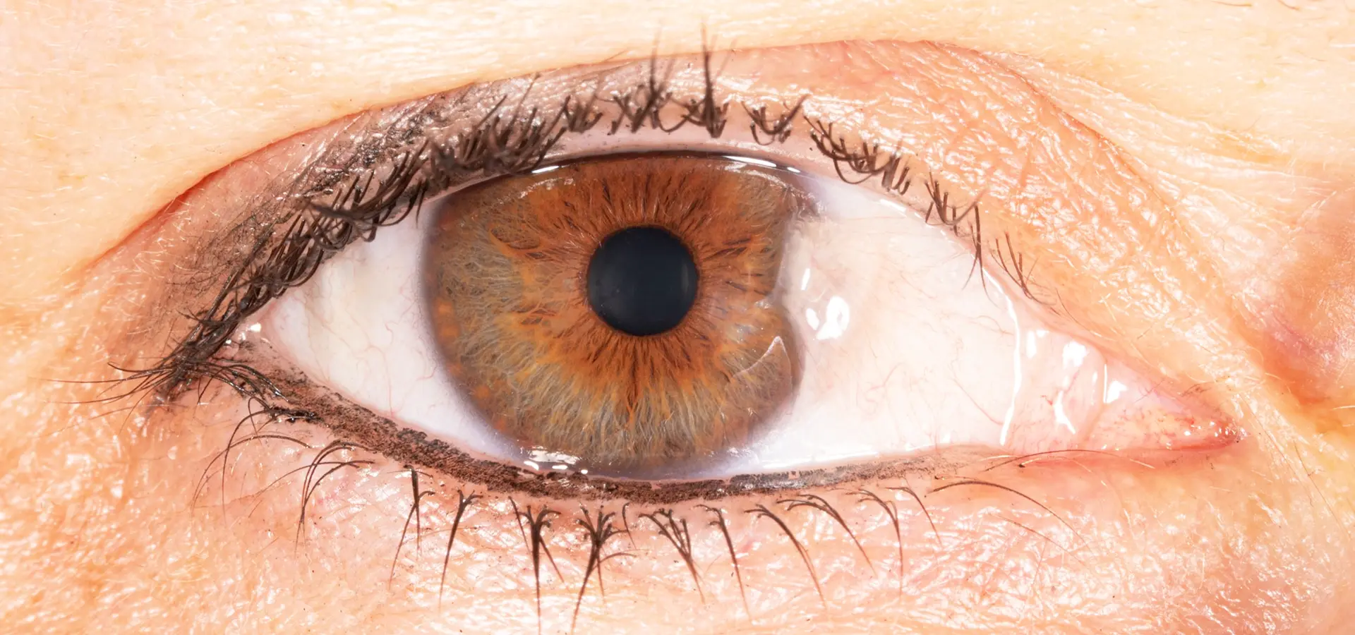 Anterior eye examination for pterygium and pinguecula at Eyecare Concepts Melbourne