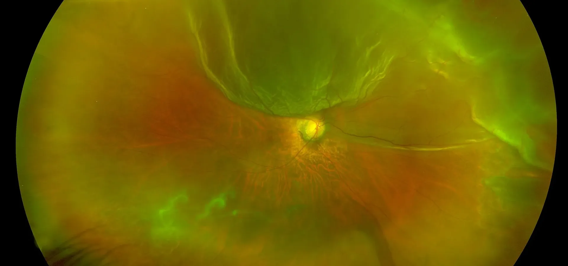 Illustration of a detached retina at the back of the eye
