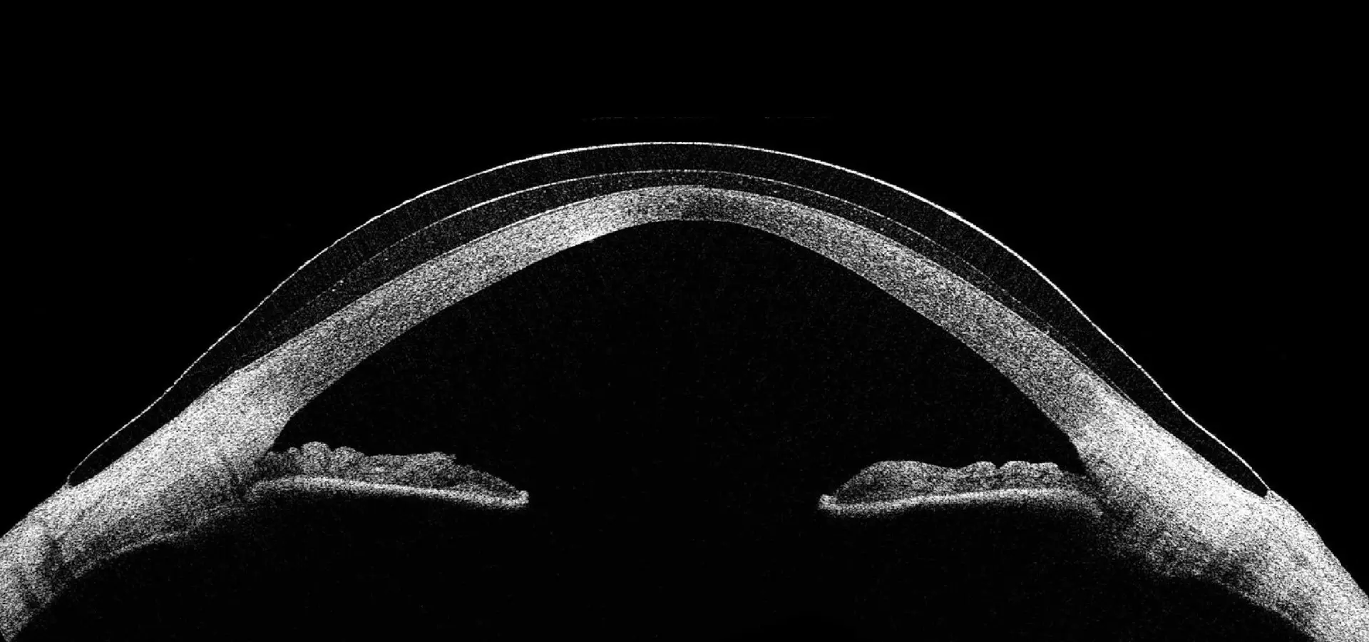 Scleral contact lens vaulting over the cornea
